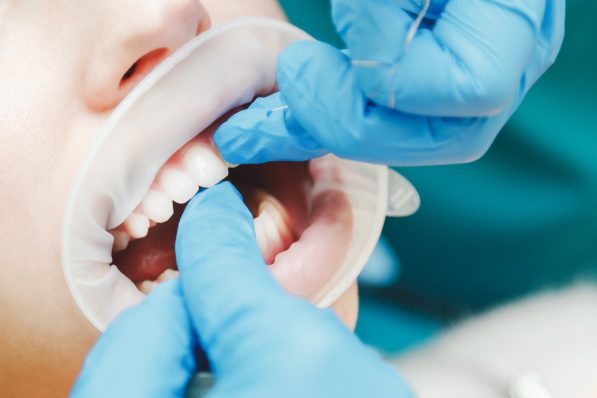 Managing Ozempic-Induced Dry Mouth